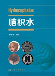 脑积水