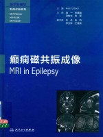 癫痫磁共振成像